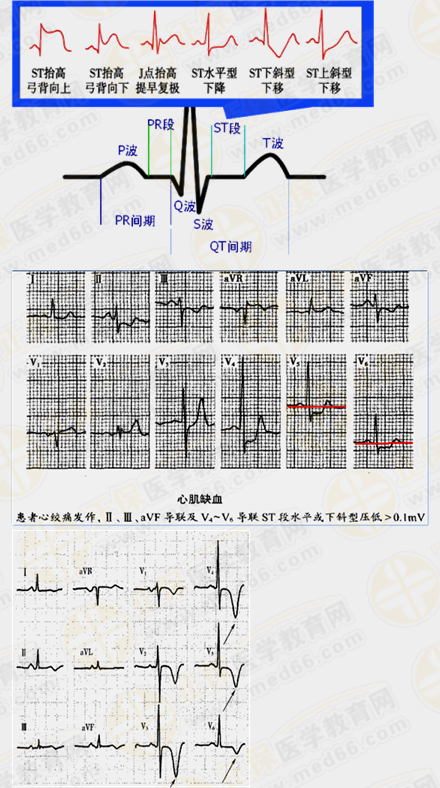 心肌缺血心電圖特點