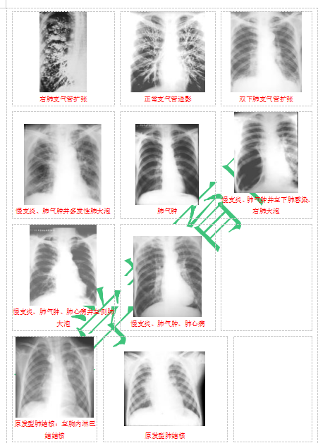 快收藏！臨床助理醫(yī)師實踐技能62個胸片（圖片診斷）