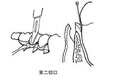 翻瓣術(shù)